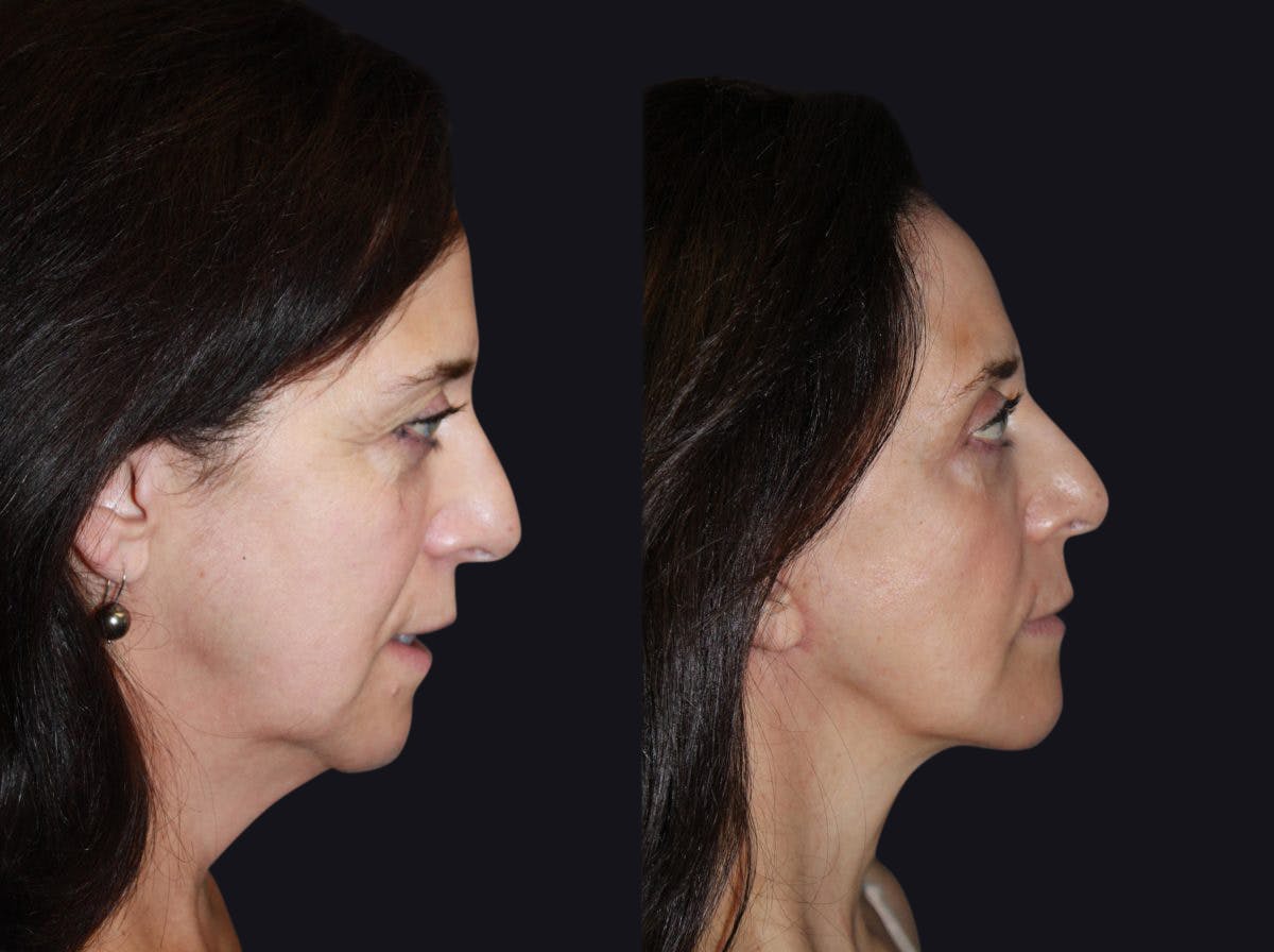 Facelift Before & After Gallery - Patient 177905860 - Image 1