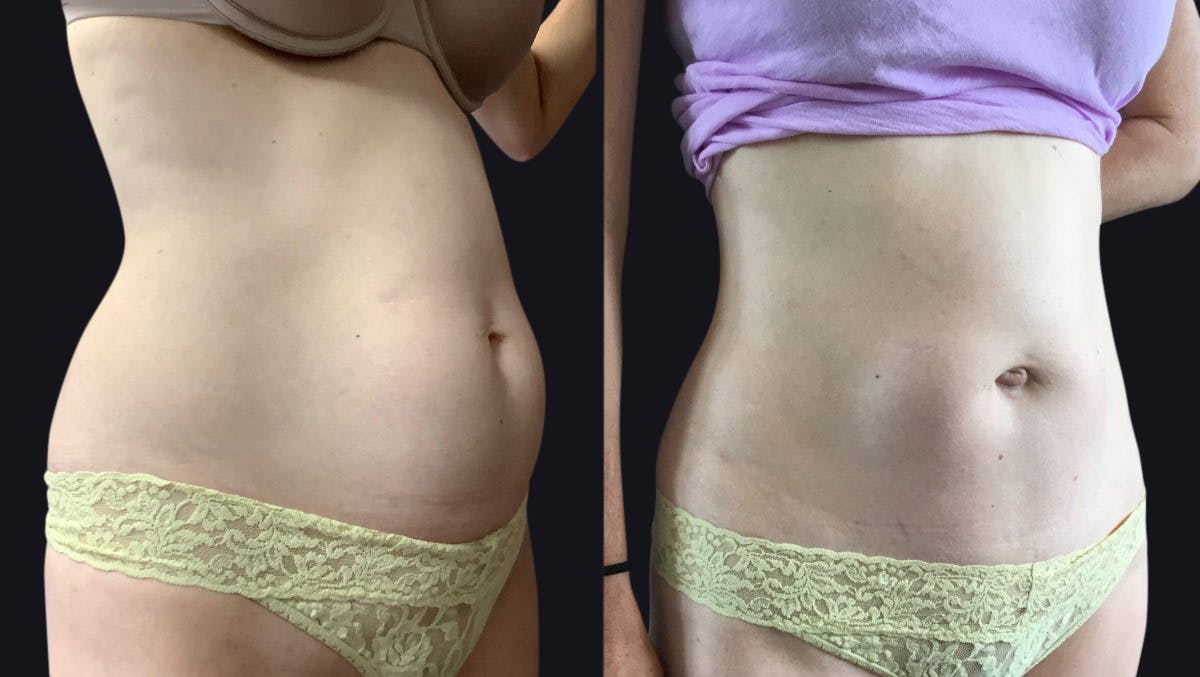 Abdominoplasty (Tummy Tuck) Before & After Gallery - Patient 177905865 - Image 2