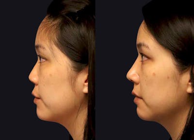Rhinoplasty Before & After Gallery - Patient 177905861 - Image 1