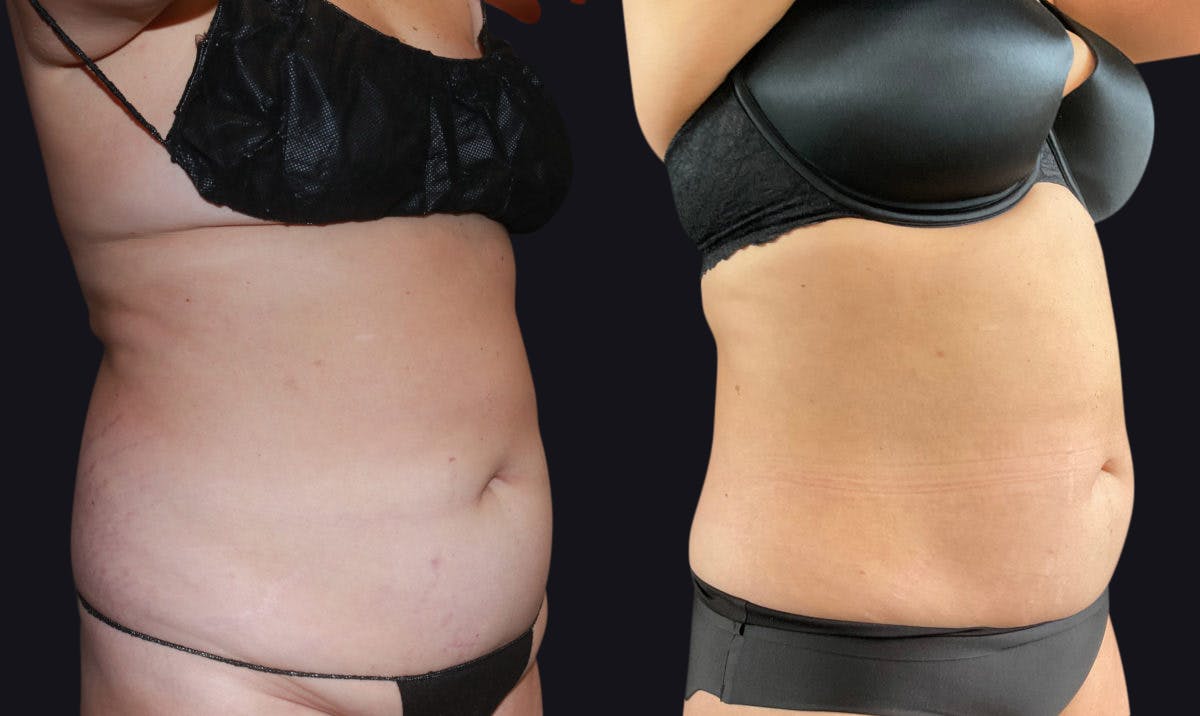 Liposuction Before & After Gallery - Patient 177905862 - Image 2