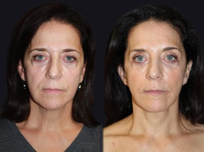 Facelift Before & After Gallery - Patient 177905860 - Image 1