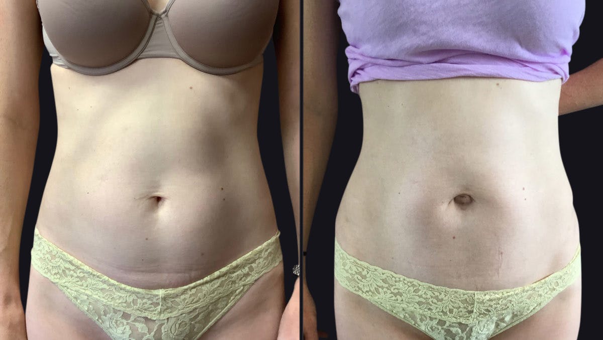Abdominoplasty (Tummy Tuck) Before & After Gallery - Patient 177905865 - Image 1
