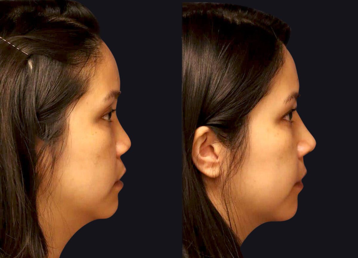 Rhinoplasty Before & After Gallery - Patient 177905861 - Image 4