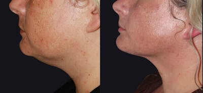 Neck Liposuction Before & After Gallery - Patient 177905859 - Image 1