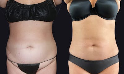 Liposuction Before & After Gallery - Patient 177905862 - Image 1