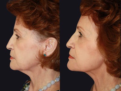 Facelift Before & After Gallery - Patient 177905858 - Image 1