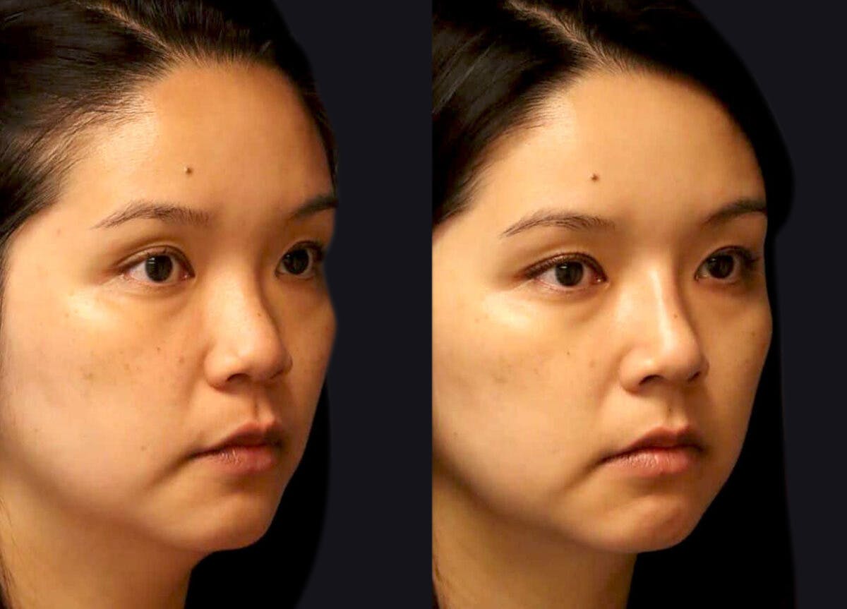 Rhinoplasty Before & After Gallery - Patient 177905861 - Image 3