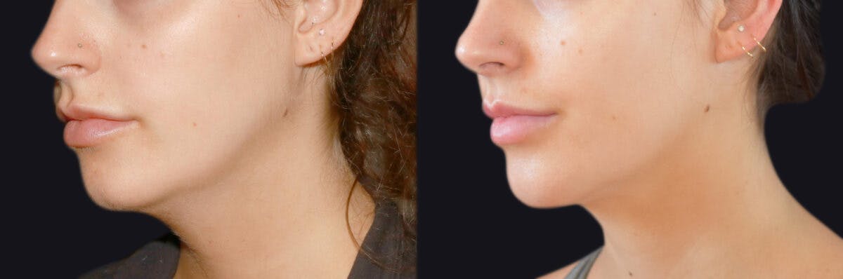 Neck Liposuction Before & After Gallery - Patient 177905848 - Image 2