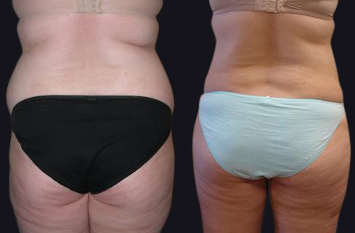 Liposuction Before & After Gallery - Patient 177905847 - Image 2