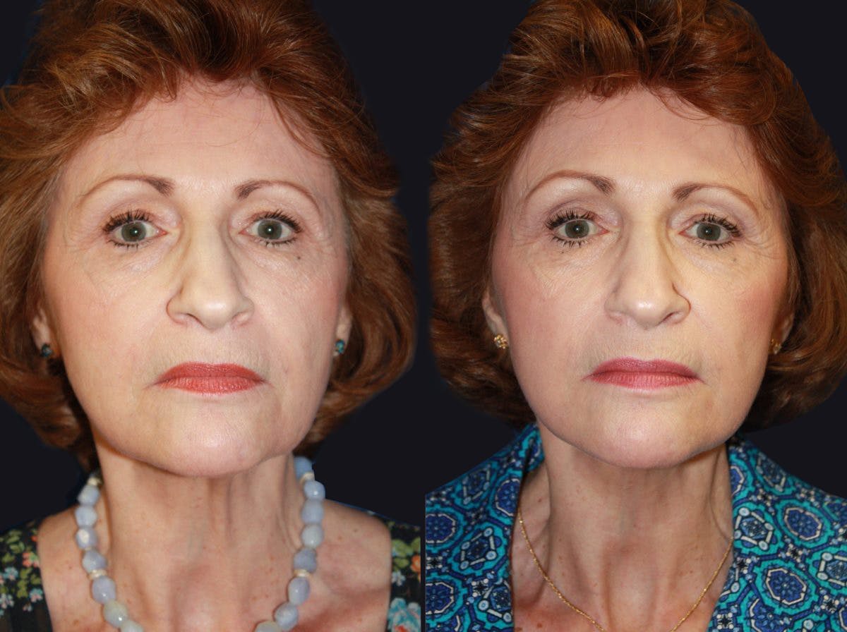 Facelift Before & After Gallery - Patient 177905858 - Image 2