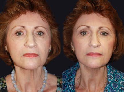 Facelift Before & After Gallery - Patient 177905858 - Image 1