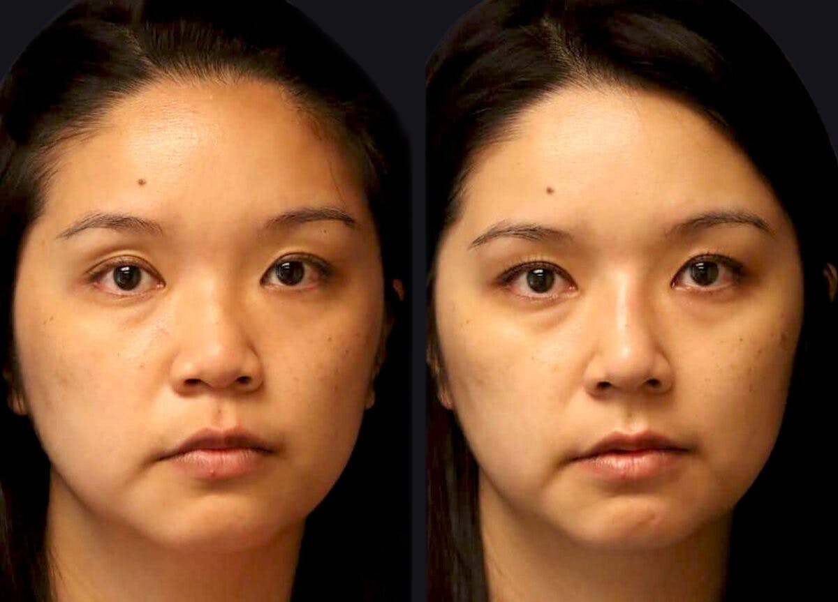 Rhinoplasty Before & After Gallery - Patient 177905861 - Image 2