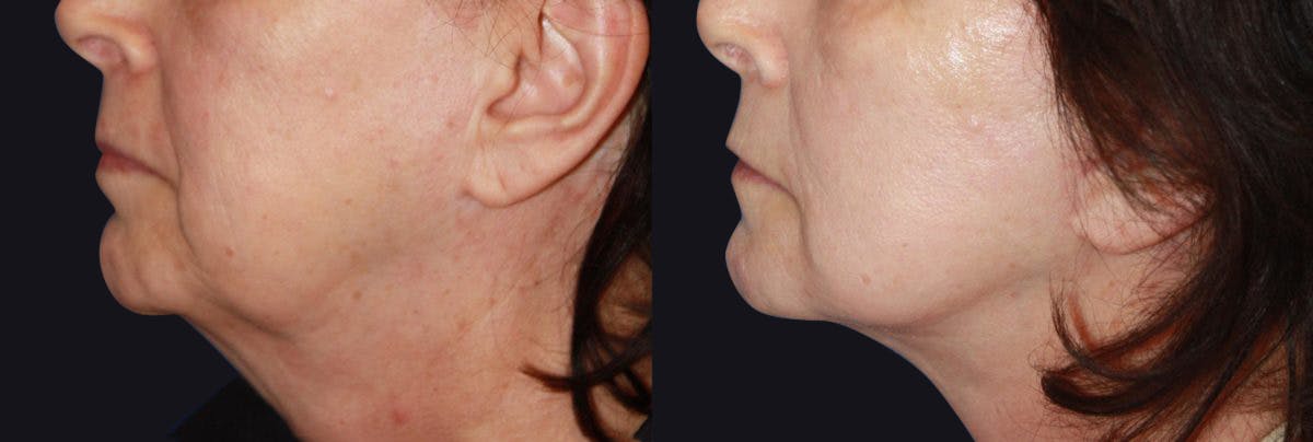 Neck Lift Before & After Gallery - Patient 116041 - Image 1