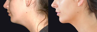Neck Liposuction Before & After Gallery - Patient 177905848 - Image 1