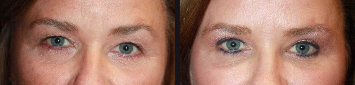Blepharoplasty Before & After Gallery - Patient 177905845 - Image 1