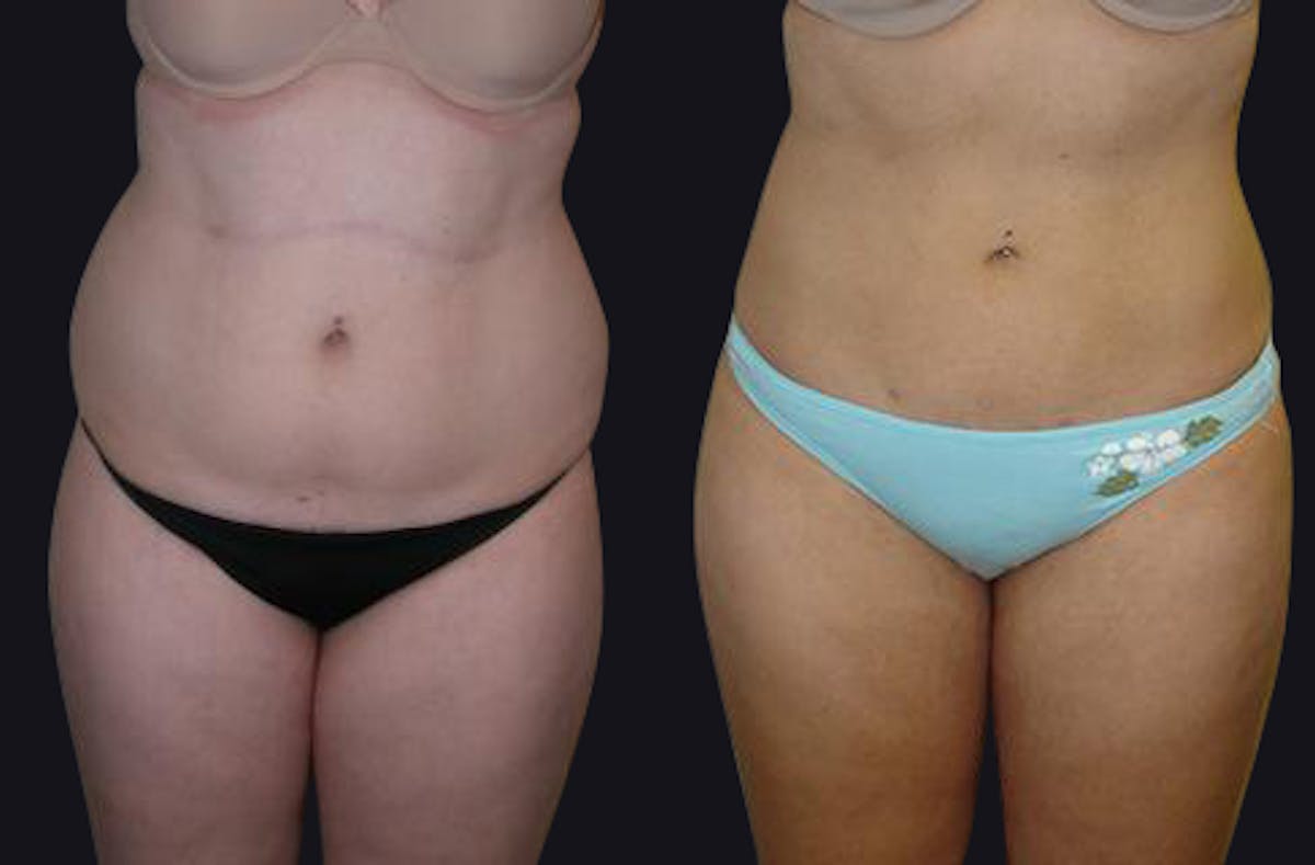 Liposuction Before & After Gallery - Patient 177905847 - Image 1