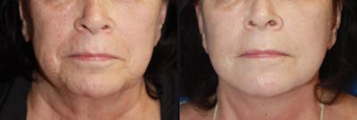 Neck Lift Before & After Gallery - Patient 116041 - Image 1