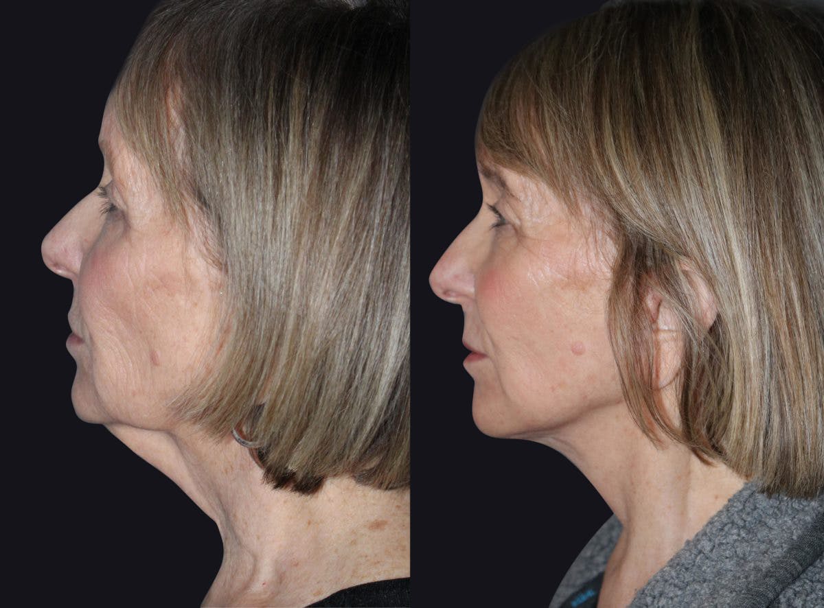 Facelift Before & After Gallery - Patient 177905844 - Image 1