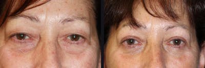 Blepharoplasty Before & After Gallery - Patient 177905841 - Image 1