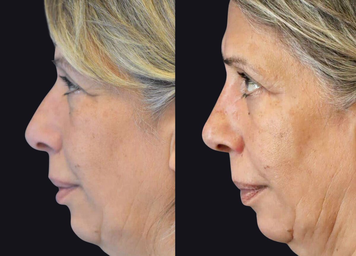 Rhinoplasty Before & After Gallery - Patient 177905840 - Image 1