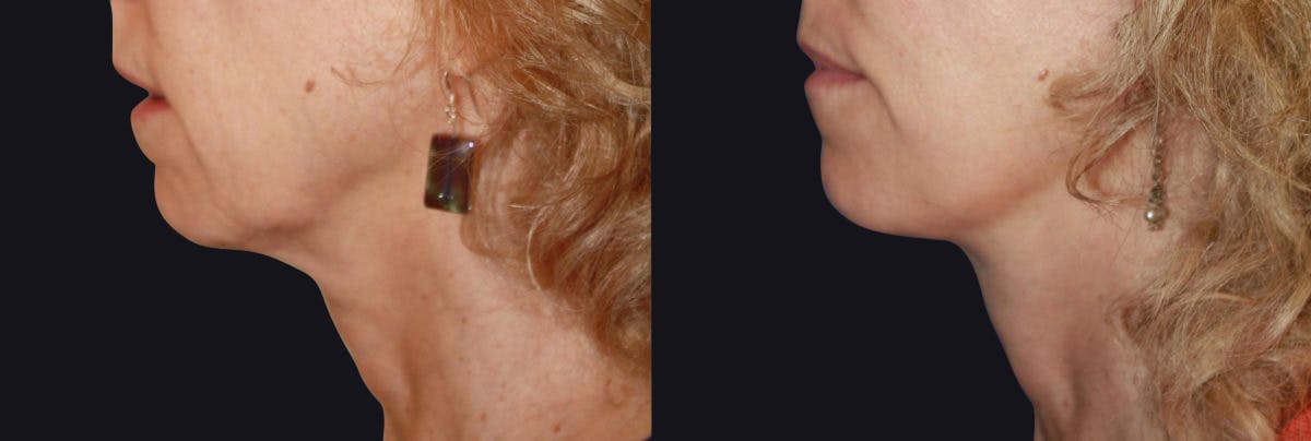 Neck Lift Before & After Gallery - Patient 177905838 - Image 1
