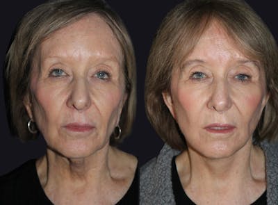 Facelift Before & After Gallery - Patient 177905844 - Image 1
