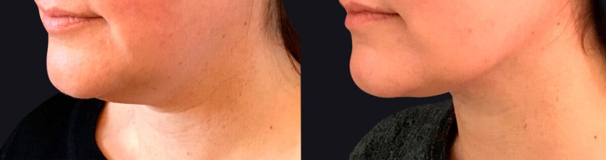 Neck Liposuction Before & After Gallery - Patient 177905837 - Image 2