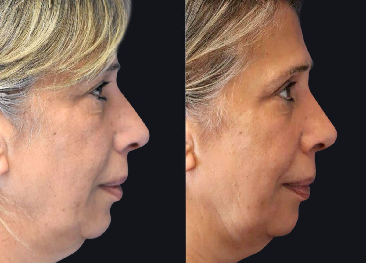 Rhinoplasty Before & After Gallery - Patient 177905840 - Image 4