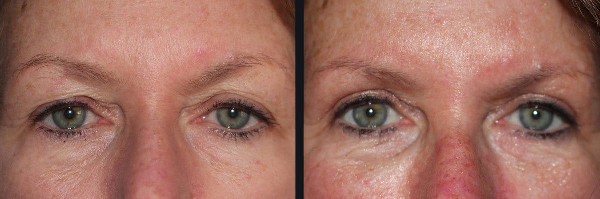 Blepharoplasty Before & After Gallery - Patient 177905833 - Image 1