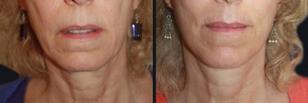 Neck Lift Before & After Gallery - Patient 177905838 - Image 2