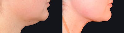 Neck Liposuction Before & After Gallery - Patient 177905837 - Image 1