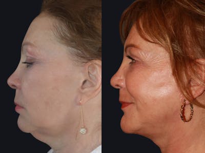 Facelift Before & After Gallery - Patient 177905832 - Image 1