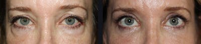 Blepharoplasty Before & After Gallery - Patient 177905831 - Image 1