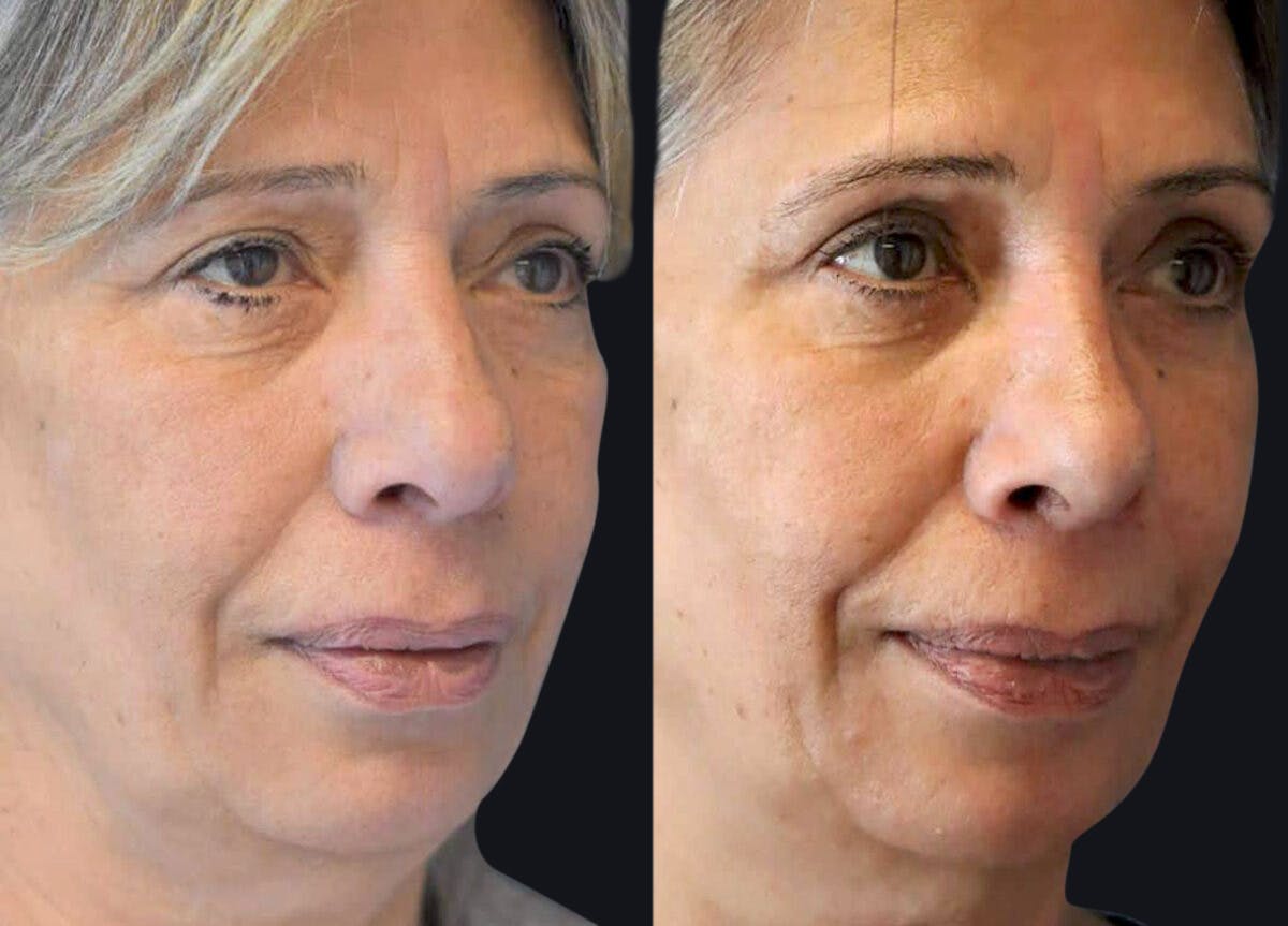 Rhinoplasty Before & After Gallery - Patient 177905840 - Image 3