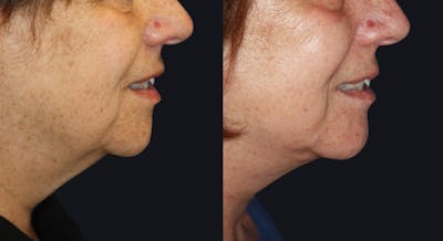 Neck Lift Before & After Gallery - Patient 177905830 - Image 1