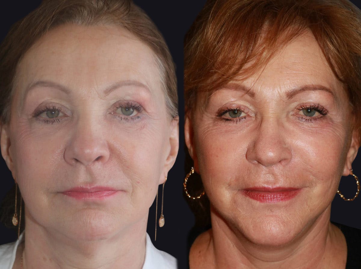 Facelift Before & After Gallery - Patient 177905832 - Image 2