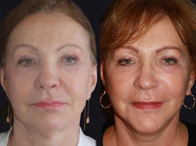 Facelift Before & After Gallery - Patient 177905832 - Image 1