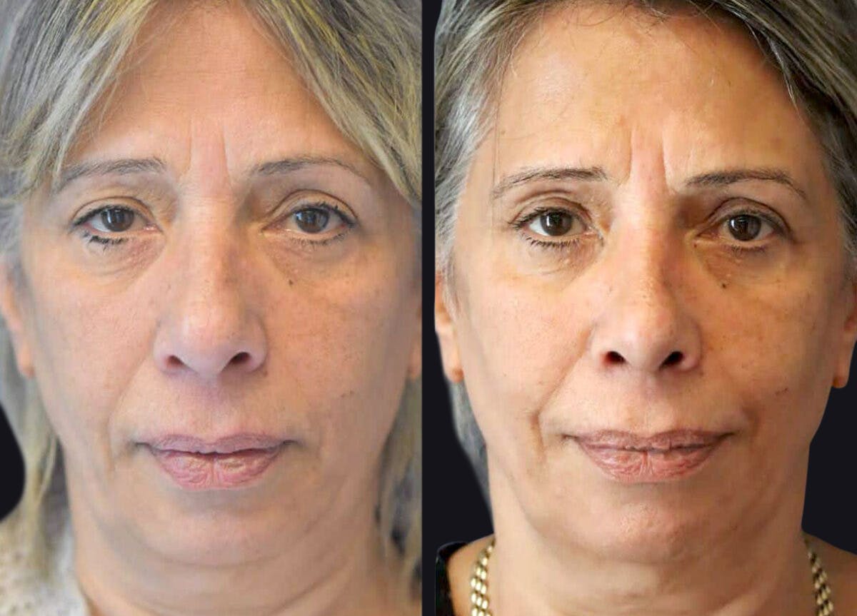 Rhinoplasty Before & After Gallery - Patient 177905840 - Image 2