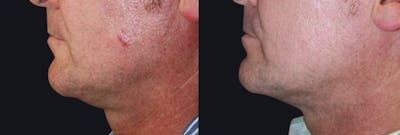 Neck Rejuvenation Before & After Gallery - Patient 177905829 - Image 1