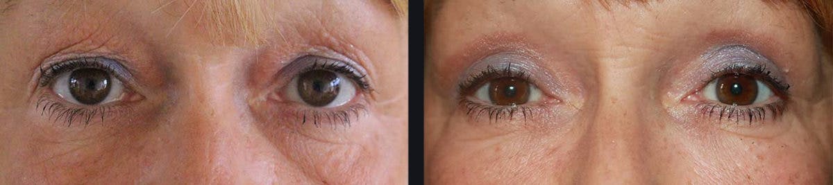 Blepharoplasty Before & After Gallery - Patient 177905828 - Image 1