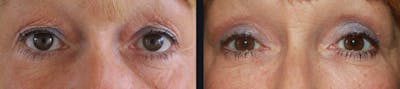 Blepharoplasty Before & After Gallery - Patient 177905828 - Image 1
