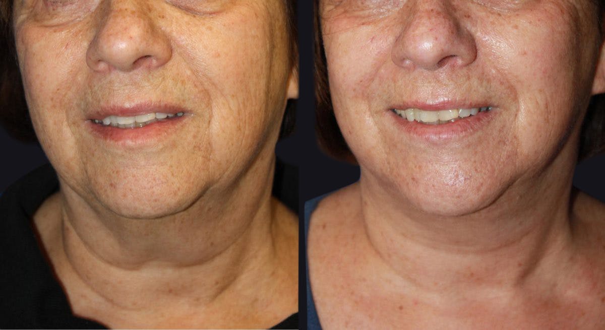 Neck Lift Before & After Gallery - Patient 177905830 - Image 2