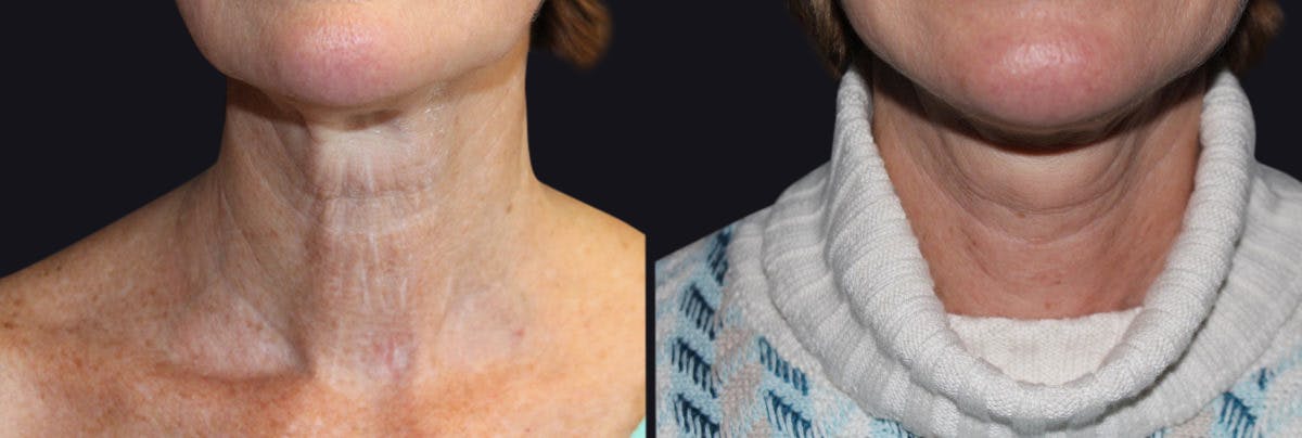 Neck Rejuvenation Before & After Gallery - Patient 177905821 - Image 1