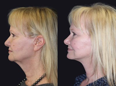Facelift Before & After Gallery - Patient 177905820 - Image 1
