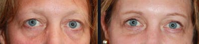 Blepharoplasty Before & After Gallery - Patient 177905819 - Image 1