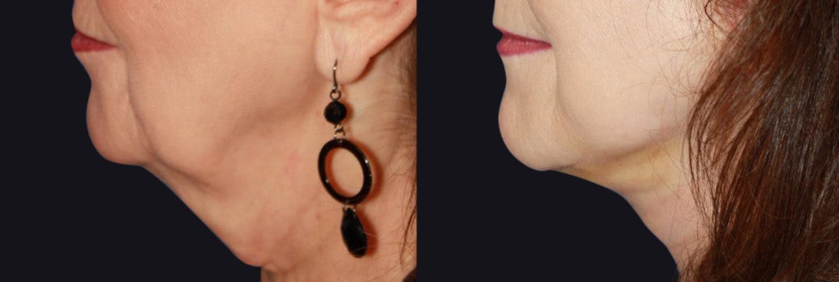 Neck Lift Before & After Gallery - Patient 177905818 - Image 1