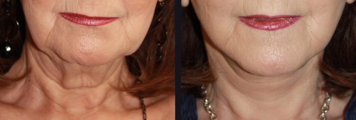 Neck Lift Before & After Gallery - Patient 177905818 - Image 2