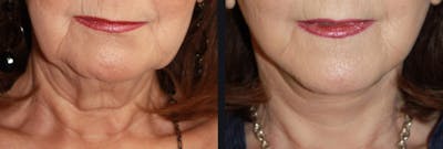 Neck Lift Before & After Gallery - Patient 177905818 - Image 1