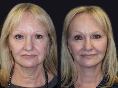 Facelift Before & After Gallery - Patient 177905820 - Image 1