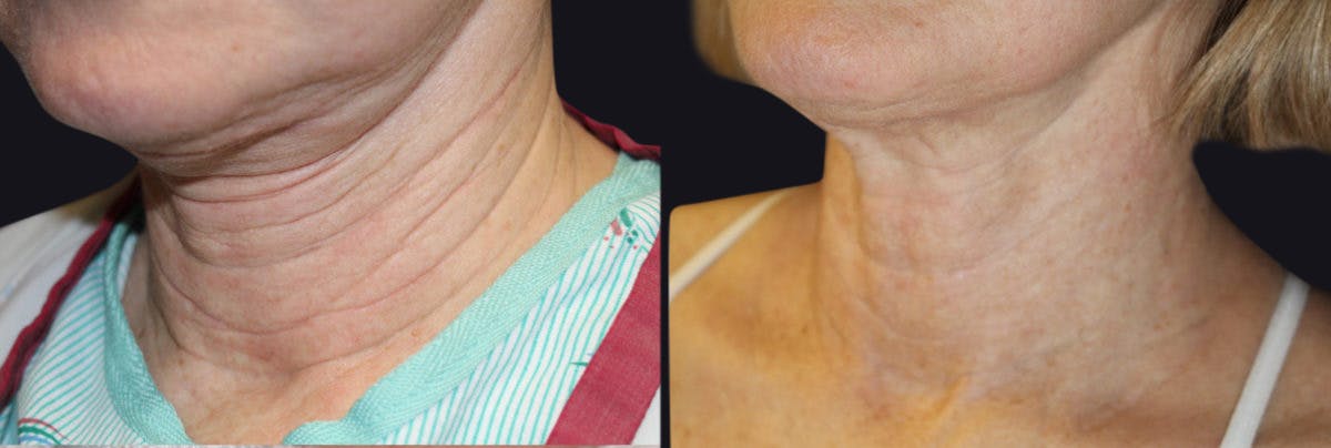 Neck Rejuvenation Before & After Gallery - Patient 177905817 - Image 1